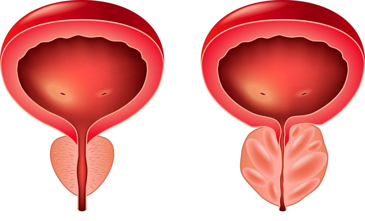 normali ir serganti prostata