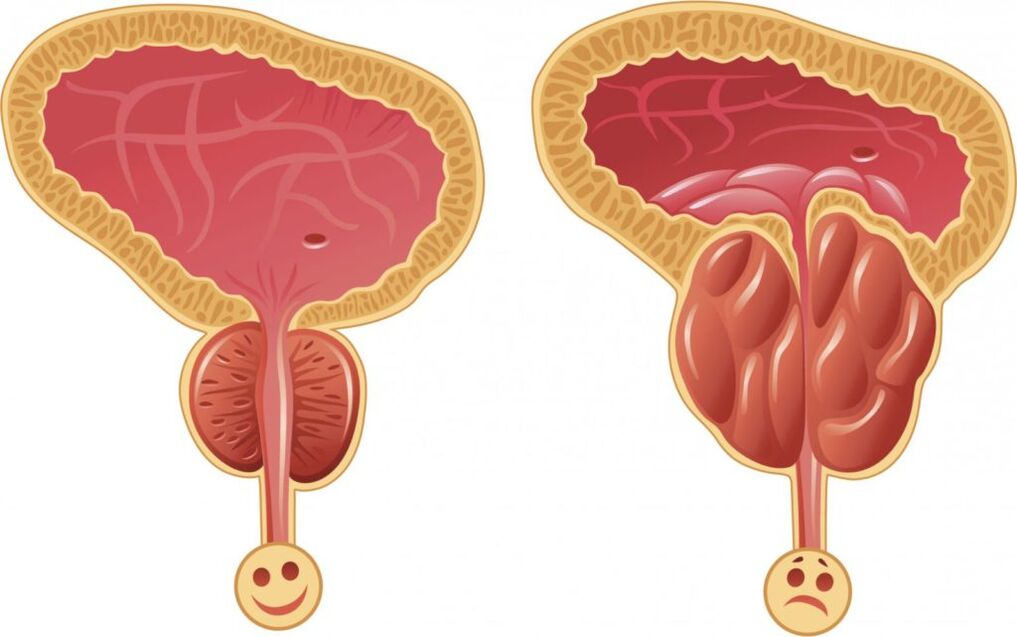 vyrų prostatito simptomai